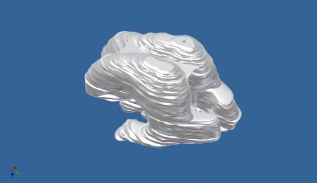 The full assembly of the hydrocephalus brain CAD image