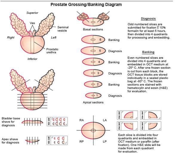 This picture depicts the procedure and analysis our client performs on a prostate. As, seen the entire prostate is dyed, the left black and the right red, merely for orientation purposes. Next, a series of slices are taken, each of which are approximately 3mm in thickness. From these slices, the odd numbered ones are situated for fixation in formulin for at least 5 hours and then approriately analyzed and diagnosed. The even number slices are divided into four quadracnts, stained, froze and stored for future parafin slide processes. 