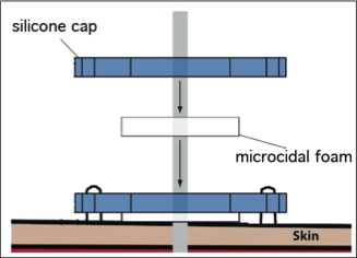 A depiction of the final product, the silicone cap integrates with the antimicrobial foam disc and then is sutured down onto the skin.
