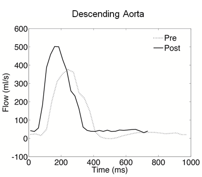 Flow diagram of one cardiac cycle in the descending aorta of a subject using the device both pre- and post-exercise