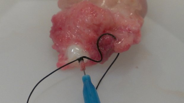 Cannulated Ovarian Artery