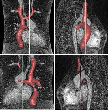 TCPC MRI Scan