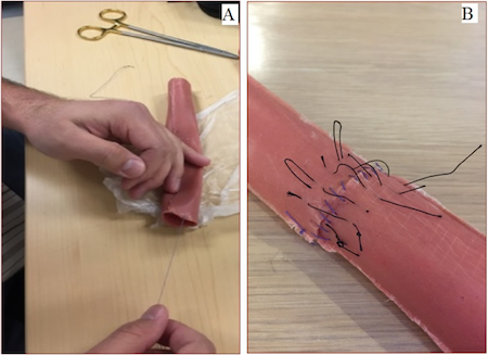 Dr. Nathwani running a stitch through the synthetic small bowel prototype. B) the synthetic small bowel post-resection and anastomosis simulation.